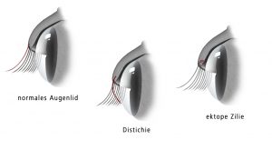 Was sind Distichien und ektope Zilien?