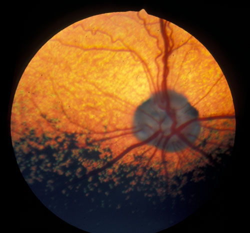 Netzhautuntersuchung