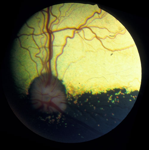 Netzhautuntersuchung