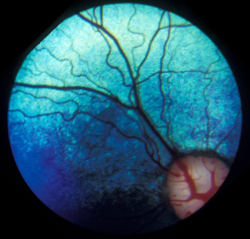 Netzhautuntersuchung