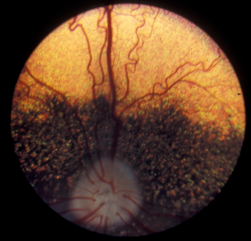 Netzhautuntersuchung