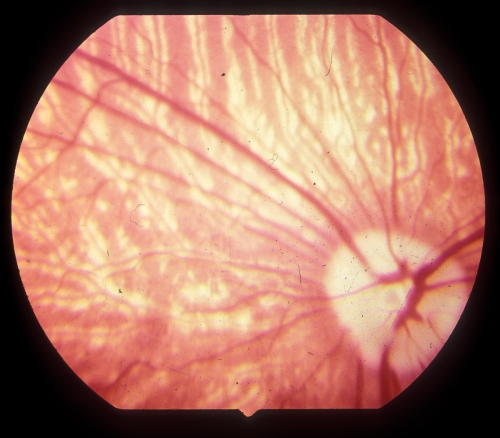 Netzhautuntersuchung