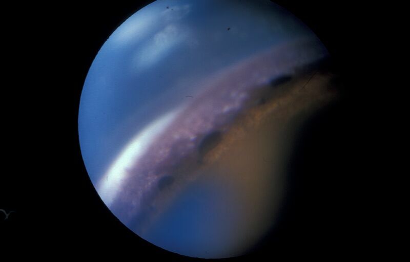 Veränderter Kammerwinkel