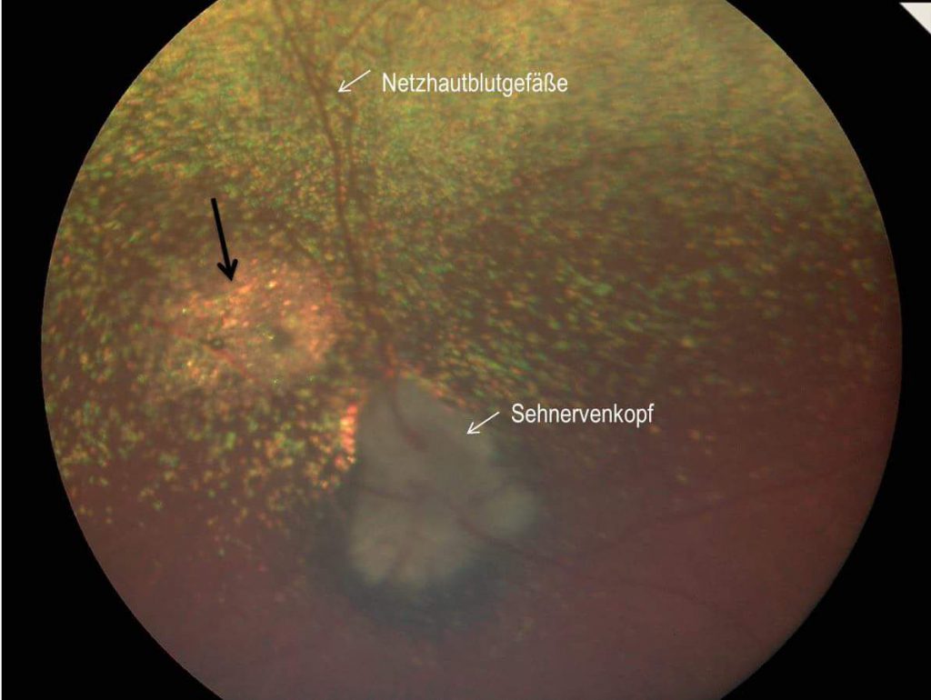 Netzhautfotografie