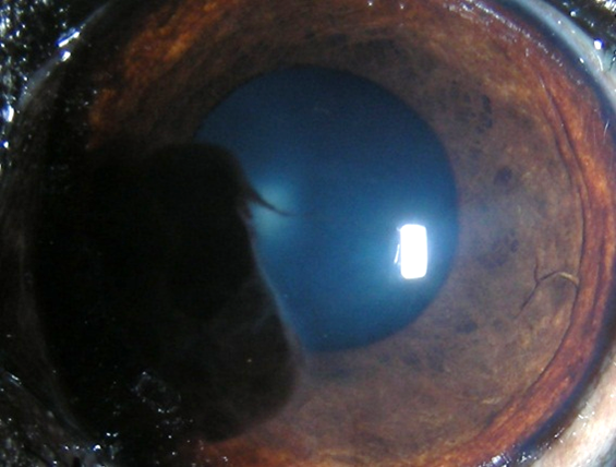 pigmentierenden Hornhautentzündung