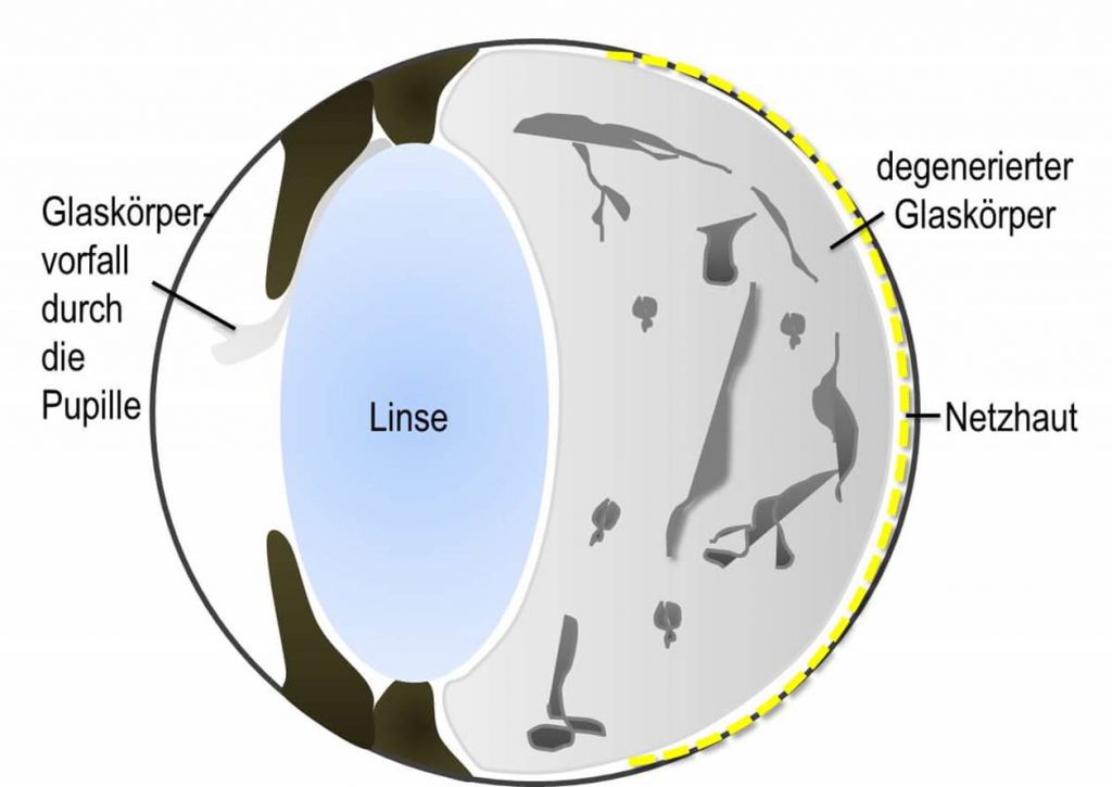 Auge mit erkranktem Glaskörper