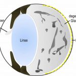 Auge mit erkranktem Glaskörper