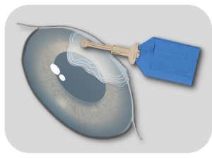 Abrasio corneae bei Ulcus recurrens