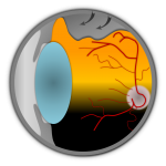 Netzhaut Retinopexie