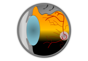 Netzhaut – Retinopexie