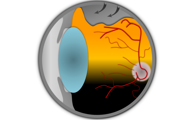 Netzhaut Retinopexie