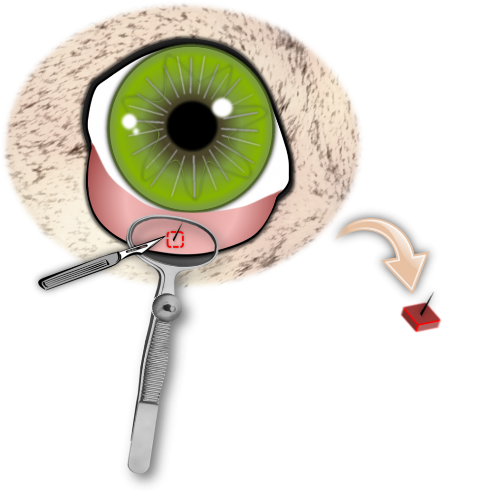 Operation Der Fehlgerichteten Haare 4