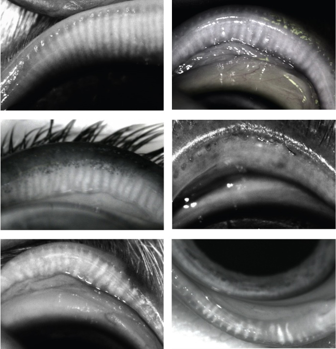 Meibography Vorschau